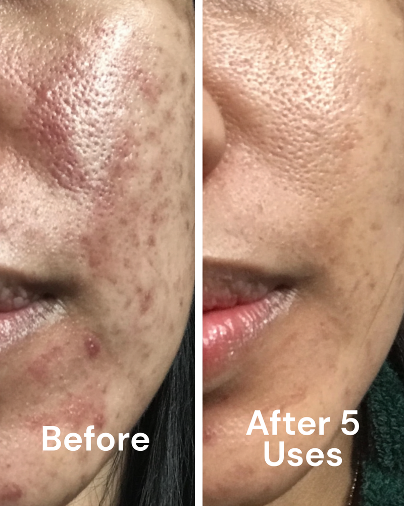 Before and after — Melasma