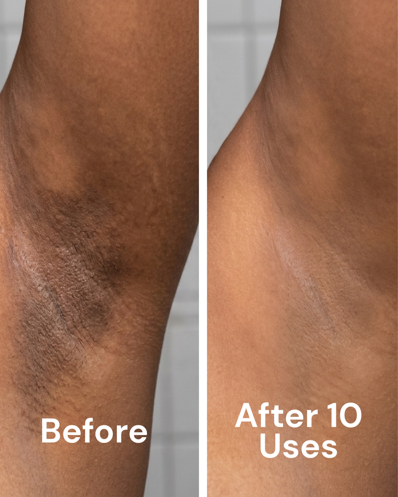 Before and after — Acne PIH