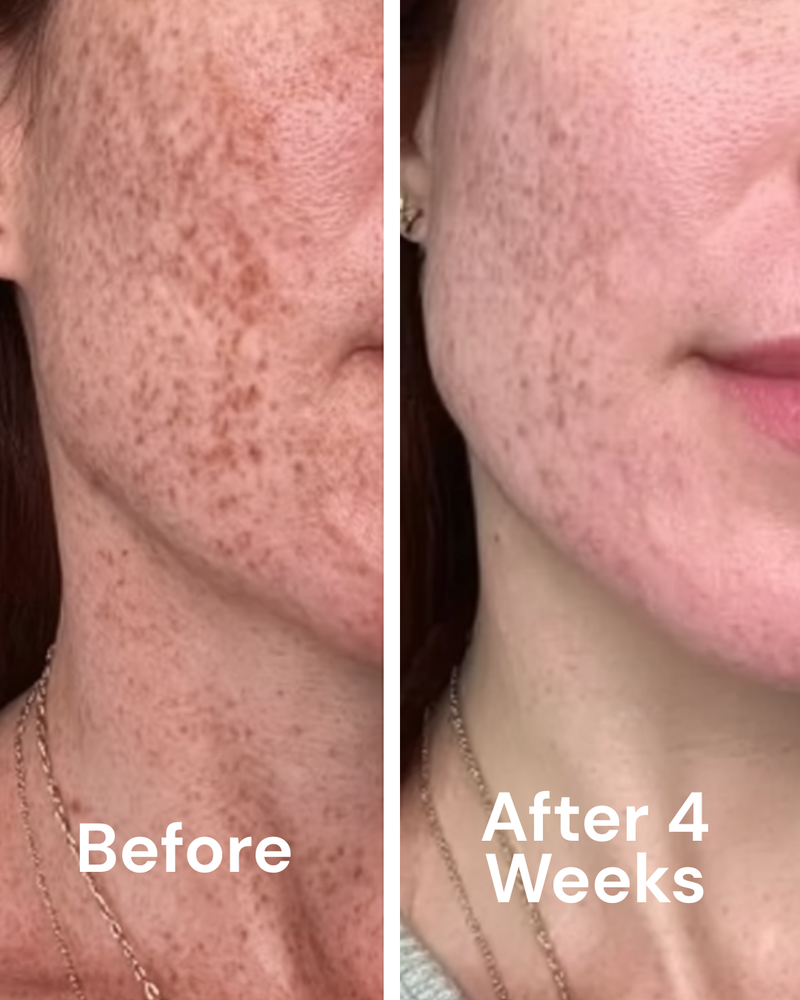 Before and after — Eczema PIH