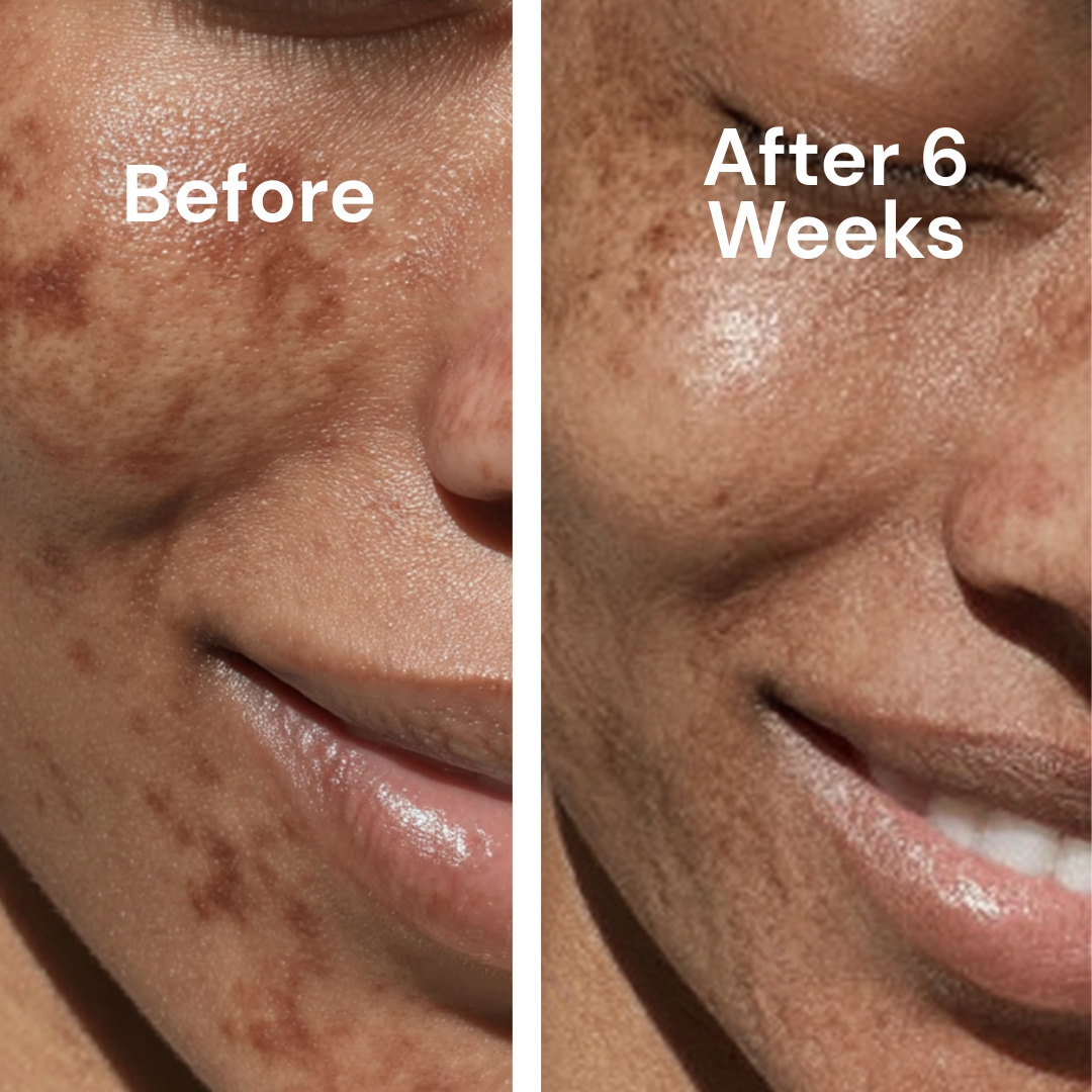 Tone Brightening Booster for Hyperpigmentation