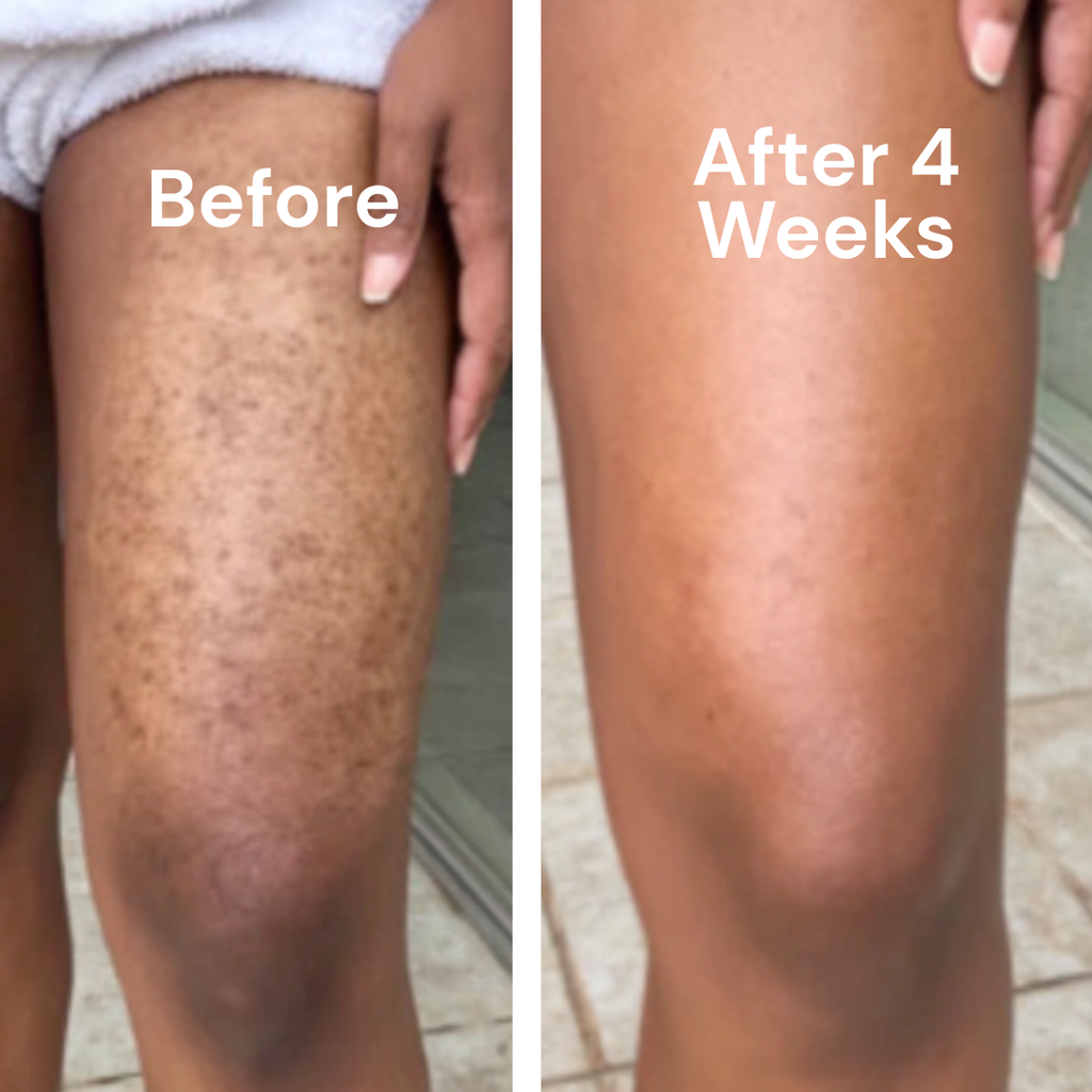 Tone Brightening Booster for Hyperpigmentation